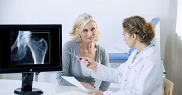 Mi a legjobb csontritkulás ellen? Ebből tudhatja, ha meggyengültek a csontjai