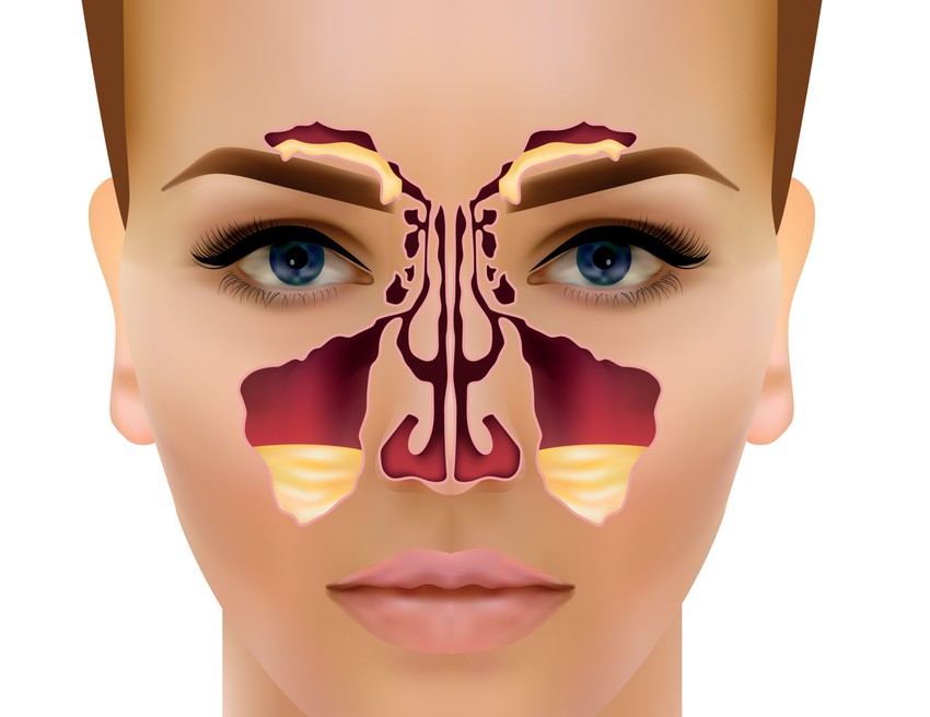 Az orrdugulás kezelése, megszüntetése nem csupán kényelmi kérdés, de a gyógyulást is segíti. Ha az orrjáratok átjárhatók, akkor a szájon át történő légzéssel nem segítünk további kórokozókat a kihűlő nyálkahártyára, és támogatjuk a szervezet saját védelmi folyamatait.
