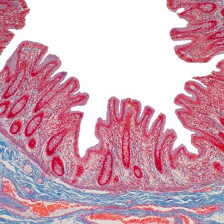 Mikroszkópos colitis: ilyen tünetekkel jár a gyulladásos bélbetegségek (IBD) harmadik típusa című cikk nyitóképe