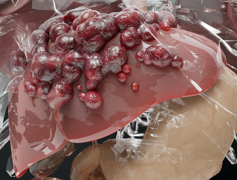 Alkoholos májkárosodás