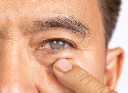 Szürkehályog műtét után: a gyógyulás hetei, amiről kevesen beszélnek című cikk nyitóképe