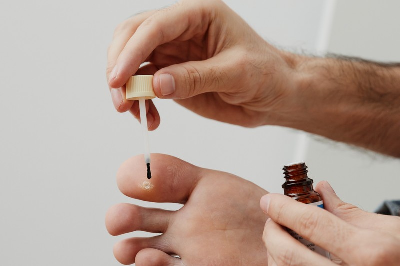 Szemölcs ellen házilag: ezek a legjobb otthoni módszerek, amik segíthetnek