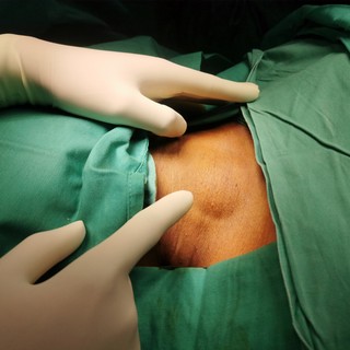 Bőr alatti csomók: nem csak rákot jelezhetnek, ennyiféle oka lehet című cikk nyitóképe