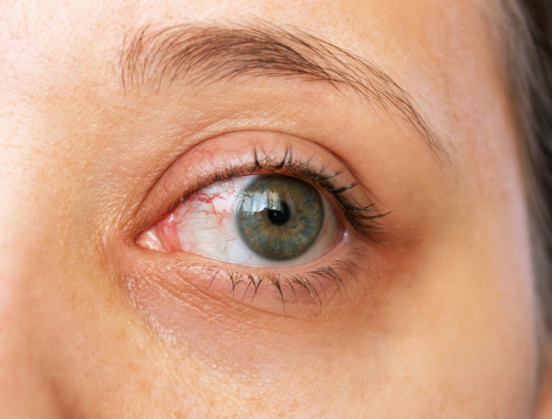 kötőhártya-gyulladás, vörös szem, váladék, viszketés