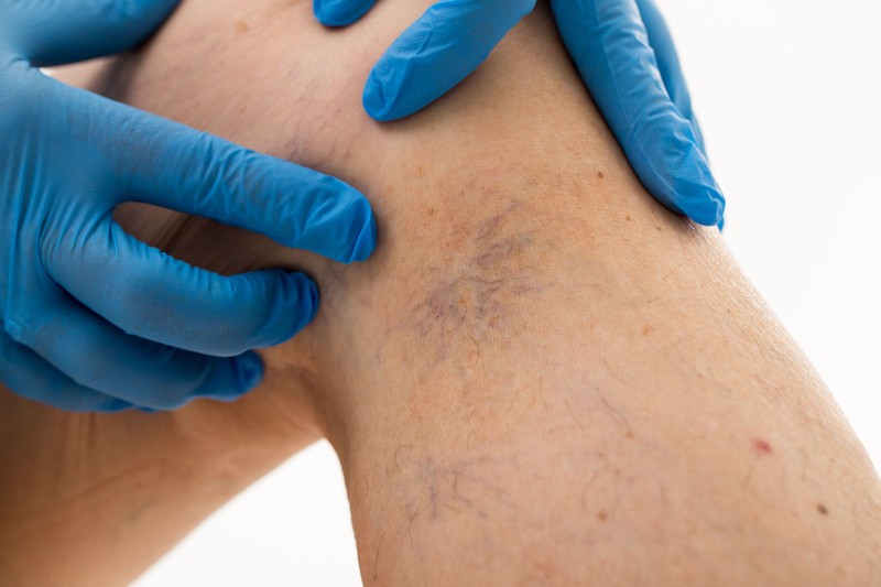 Ezzel a vizsgálattal kideríthető, vannak-e vérrögök az ereiben