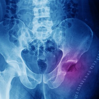 Kondroszarkóma: tünetek, vizsgálatok, kezelési lehetőségek című cikk nyitóképe