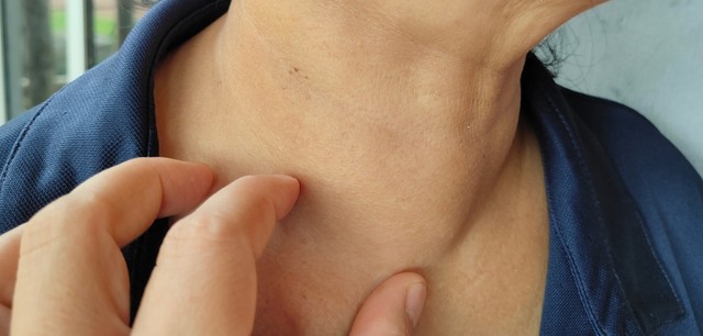 Pajzsmirigybetegség: mikor nem elég már csak a gyógyszer? Az orvos elmondja