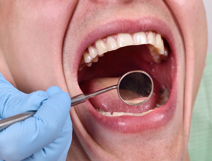 égő nyelvérzés, szájpadlás, égő, fájdalom