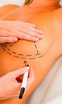 Mellműtét, plasztika utáni gyógytorna-ajánlat