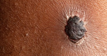  A melanóma első jelei: mit vegyen komolyan, és hogyan ismerheti fel időben a bőrrákot? 
