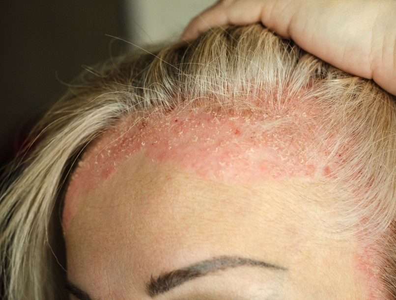 pzoriázis belobbant pikkelysömör fellángolás ellen