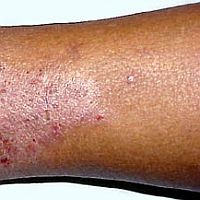 Lábszárfekély: további veszélyek