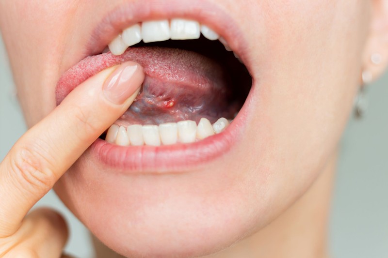 A nyelve is árulkodhat: 9 szájüregi tünet, amely B12-vitamin-hiányra figyelmeztethet