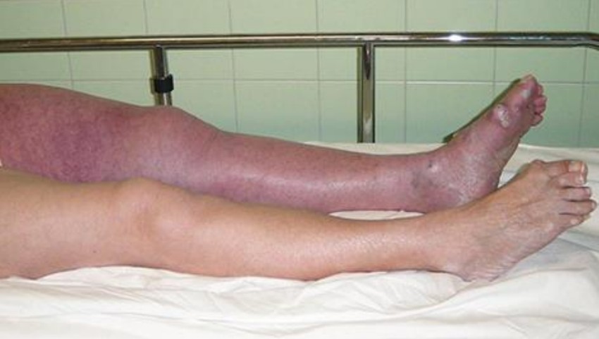 Ezek az alsó végtagban kialakuló mélyvénás trombózis tünetei.