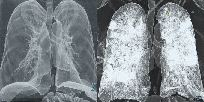Mi a tüdő CT és mit mutat ki? című cikk nyitóképe