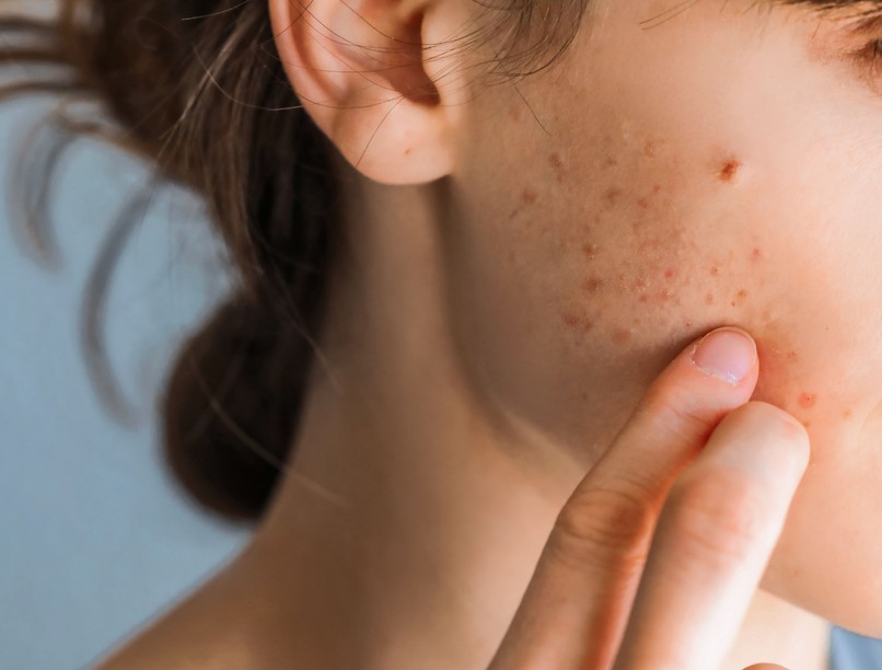 akne, pattanásos bőr, felnőttkori pattanás Mitől alakulhat ki az akne?