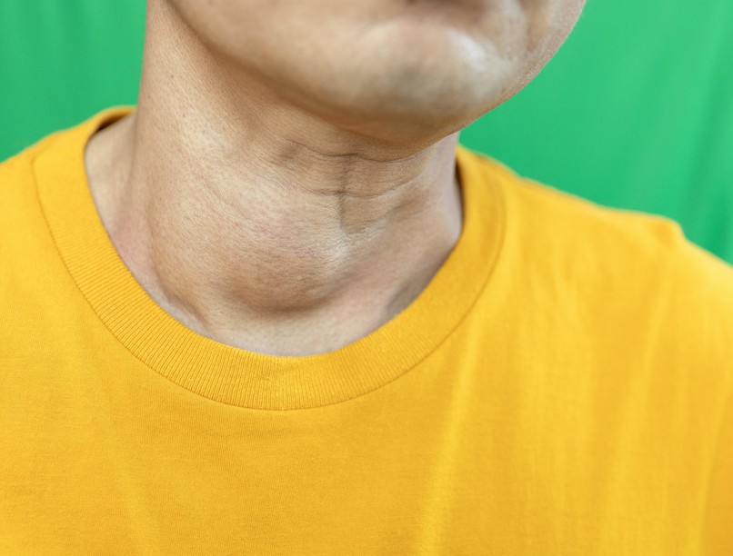 pajzsmirigy megnagyobbodas strúma golyva