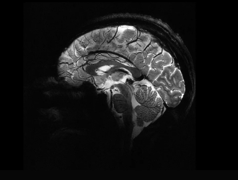MRI agyi felvétel Alzheimer Parkinson
