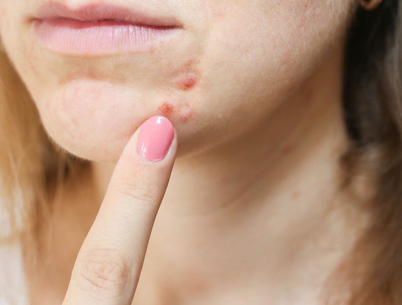 akné, hormonzavar ellen, pattanás oka, bőrprobléma tünete