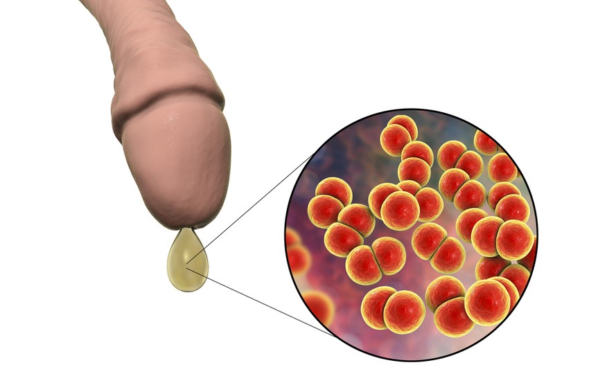 A tripper tünetei általában férfiakon látványosabbak. A fertőzést követően 2-4 nap lappangási idő után égő érzés kíséretében húgycsőfolyás jelentkezik, ami kezdetben nyákos, majd fehér-gennyes jellegű, gyakorta társul mellé vizeletürítési fájdalom és spontán húgycsőégés, melyek oka a húgycső gyulladása.