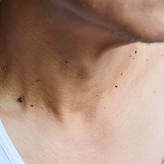 Szemölcs az arcon, a nyakon és a talpon - így írtható ki végleg című cikk nyitóképe