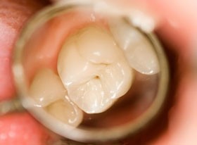 Egy gén felelős a fogak épségéért