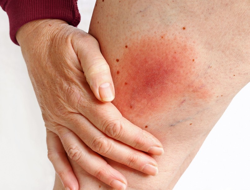 ízületi gyulladás fájdalom oka Lyme-kór