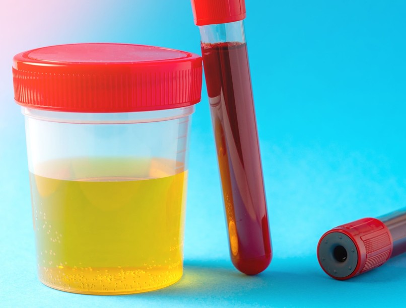 vérvétel magas húgysavszint csökkentése