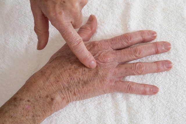 Csak egy zöldeskék foltnak, zúzódásnak hitte - megdöbbent a nő, hogy daganatos beteg