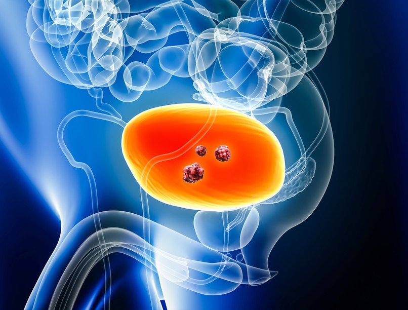 húgyhólyagdaganat tünetei tumor fájdalmas véres vizelet