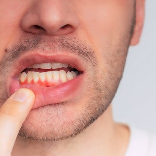 Mi az ínygyulladás? című cikk nyitóképe