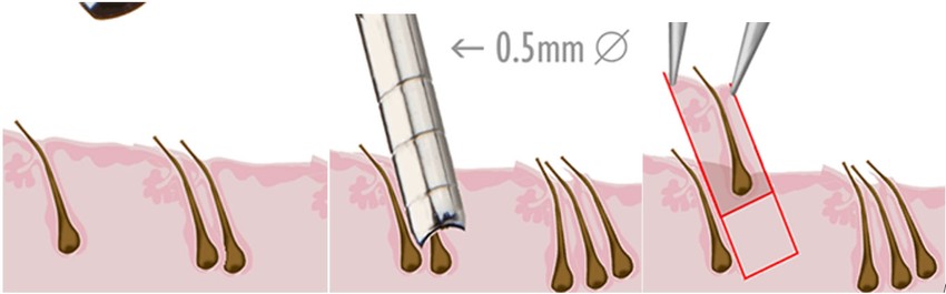 Íme, a hajbeultetes lépései (himgeurope.com)