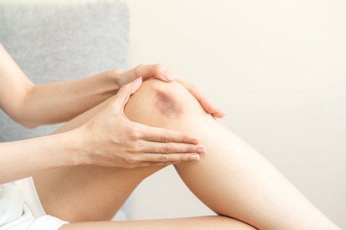 Kék-lila foltok a lábon beütés nélkül – mi okozhatja? Az orvos válaszol című cikk nyitóképe