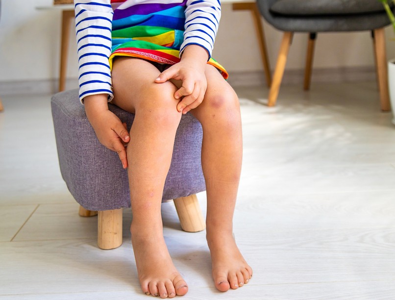 artritisz gyerek ősz tél