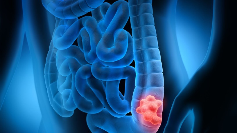 mesterséges intelligencia bélrák polip adenoma