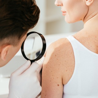 Basalioma, melanoma, spinalioma: ezek a 3 leggyakoribb bőrrák korai tünetei című cikk nyitóképe