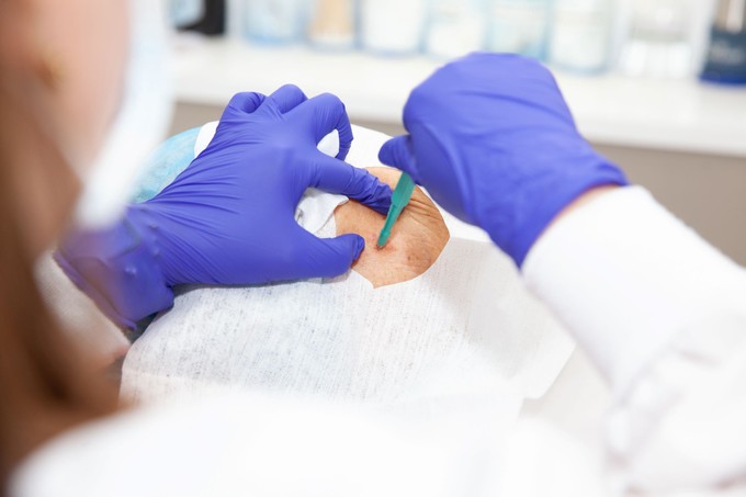 Ekkor lehet szükség bőrbiopsziára: nem csak rákgyanú esetén végzik című cikk nyitóképe