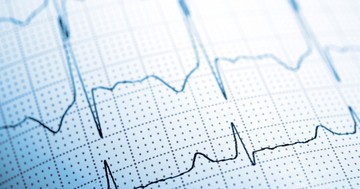 Gyorsabban olvassa az EKG-t, mint az orvosok? Egy új AI-eszköz másodpercek alatt kiszúrja a két legveszélyesebb szívbetegséget az EKG-ból