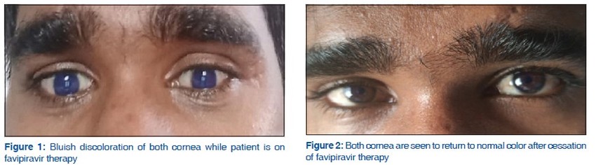 Favipiravir hatására megváltozott szemszín