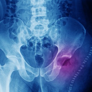 Kondroszarkóma: tünetek, vizsgálatok, kezelési lehetőségek című cikk nyitóképe