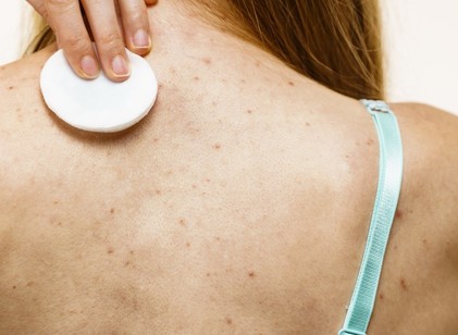 Akné a háton: mitől alakulhat ki, és mit lehet tenni ellene? című cikk nyitóképe