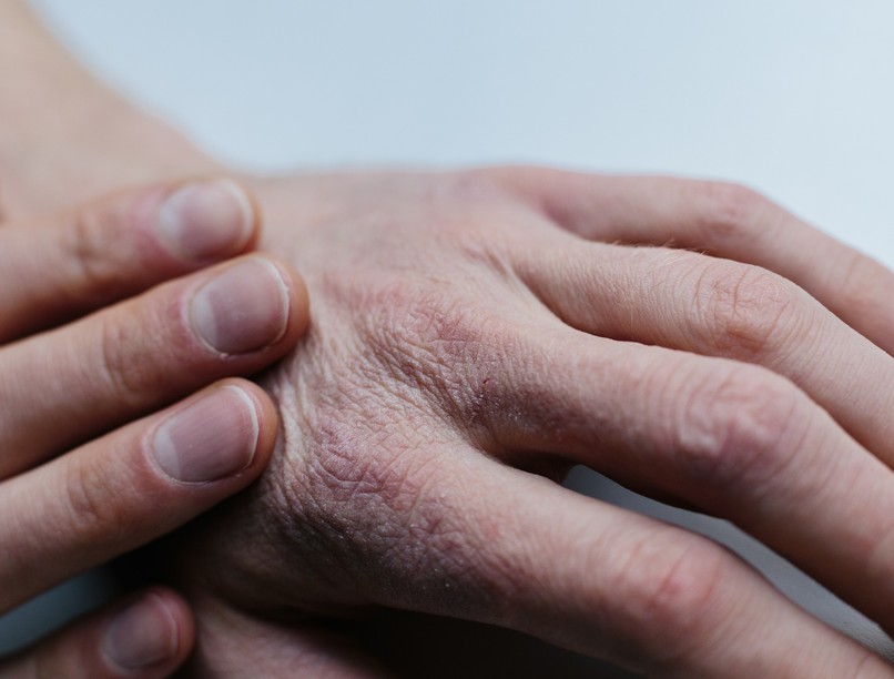 száraz cserepes bőr kézfej ápolás krém