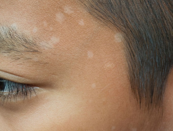 Mivel halványíthatók a zavaró napfoltok? Ezt javasolja ellene a bőrgyógyász című cikk nyitóképe