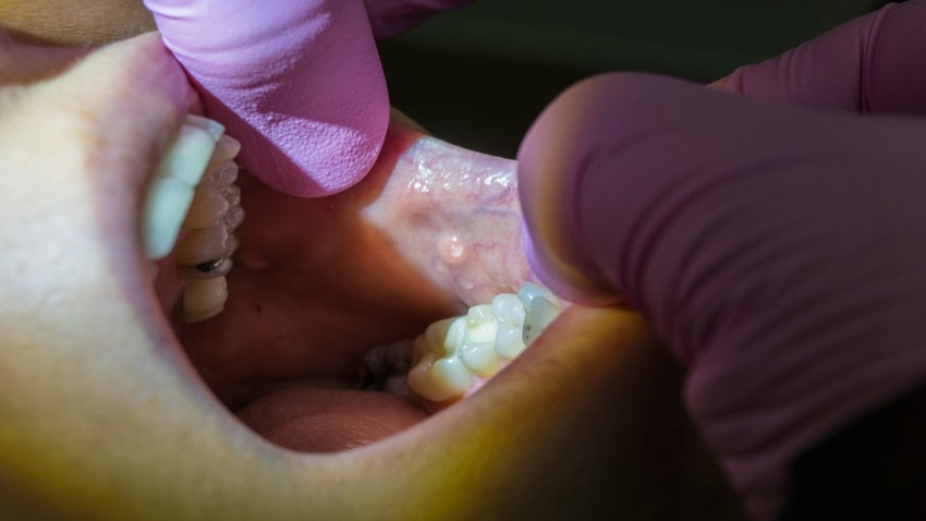 A legtöbb esetben a szájszárazság mögött nem parodontológiai probléma áll. Ilyenkor a szakorvos további vizsgálatokon való részvételt javasol.