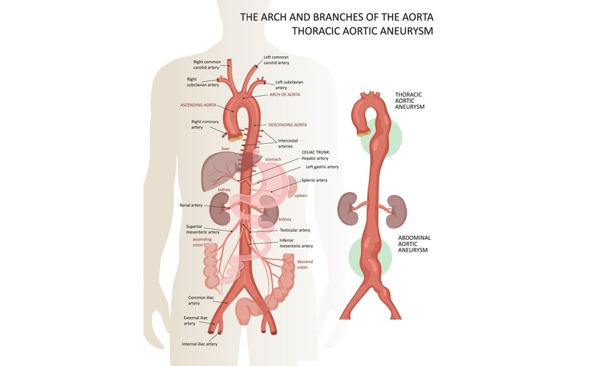 Az aneurizmatikus értágulatok az esetek döntő hányadában az artériákon jelentkeznek. Az artériás értágulatok leggyakrabban az aortán alakulnak ki, melyek az összes aneurizmák kb. 80%-át teszik ki.