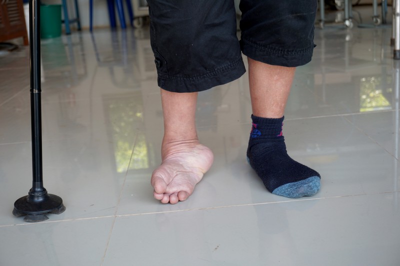 Dongaláb tünetei, vizsgálata és kezelése