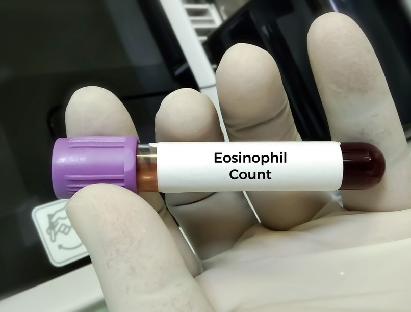 vérvétel mitől magas a eosinophil