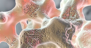 Mi az osteoporosis? Ezek a csontritkulás okai, tünetei és kezelési lehetőségei