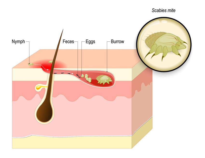 A ruhatka a vékonyabb bőrterületeket részesíti előnyben, ahová könnyebben befúrják magát (ujjak közötti területek, emlőbimbó udvara, nemi szervek és környéke).