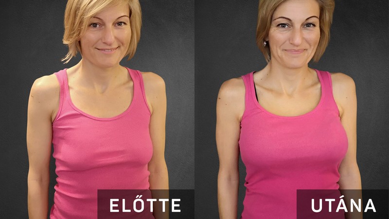 „A kórházban dolgozók mosolya sokat segített a műtét utáni fájdalom csökkentésében” – Túlesett a mellplasztikai műtéten a pályázat nyertese